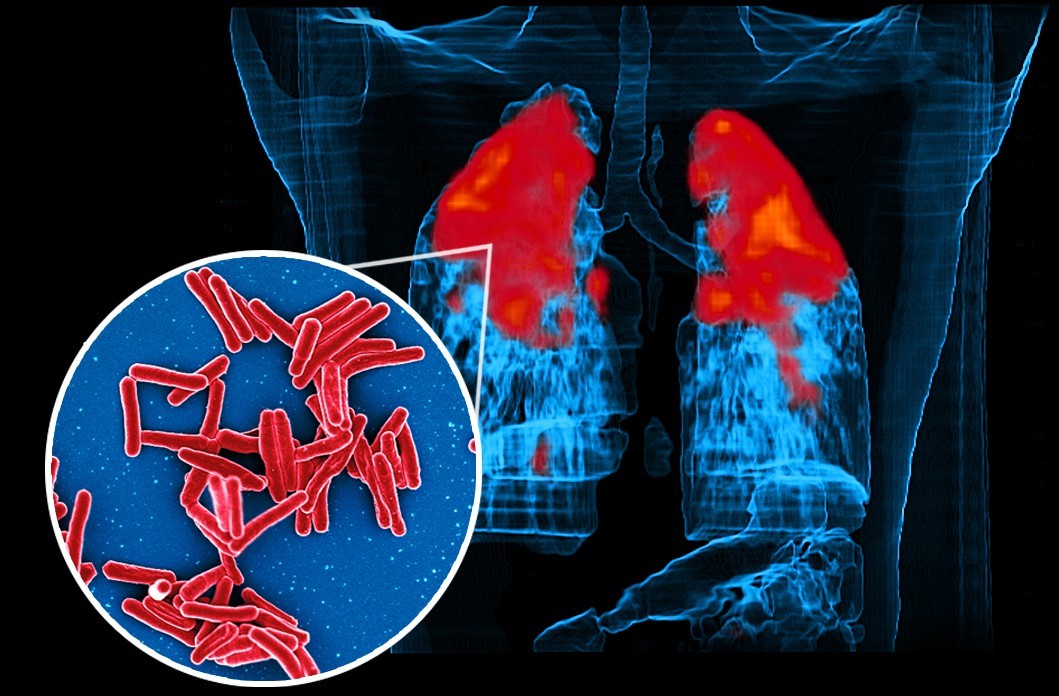 Mycobacterium Tuberculosis Bacteria, the Cause of TB. Credits: NIAID, CC BY 2.0, via Wikimedia Commons (cropped)