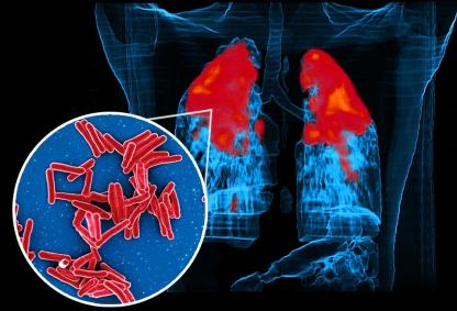 Mycobacterium Tuberculosis Bacteria, the Cause of TB. Credits: NIAID, CC BY 2.0, via Wikimedia Commons (cropped)